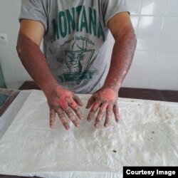 ЖЭБде жараат алган Чыңгыз Бактыбеков.