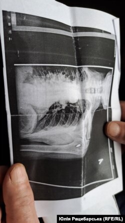 Після обстрілу, під який потрапив Анатолій, куля досі в кістці