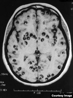 نوروسیستی سرکوزیس رایج‌ترین بیماری انگلی است که سیستم عصبی مرکزی را تحت‌تأثیر قرار می‌دهد