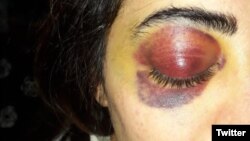 مینا یعقوبی با این آثار بر صورتش از زندان آزاد شد