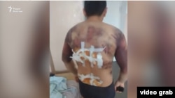 На этом фото, облетевшем социальные сети в январе, запечатлен житель города Талдыкоргана Азамат Батырбаев с множеством гематом на руках и спине, а также со следами от ожогов. Родственники и земляки Батырбаева заявили, что после задержания его избивали, тело прижигали утюгом