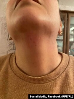 Այթեն Մամեդովան ցույց է տալիս հարձակման հետևանքները, 9-ը մայիսի, 2022թ․