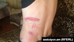Ара Мурадян показывает следы от избиения, 9 ноября 2018 г.