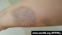 Синяки на руке Латофат Рахимовой, которая утверждает об избиении со стороны сотрудника милиции.