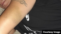 Гематомы на руке Артема Старкова (фамилия изменена), избитого ярославскими полицейскими