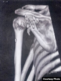 Снимок плеча без сустава Ивана Топчия