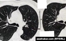 Aşgabatda COVID-19 hassasynyň öýkeniniň rentgen suraty