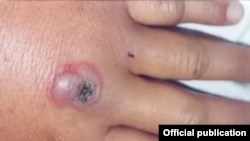 Күйдүргү. Иллюстрациялык сүрөт.