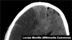 Осори хунрезии мағзӣ дар акси ташхис