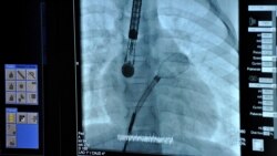 Введення оклюдера і сенсорів до аорти. Зображення передається з сенсора на екран