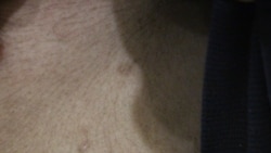 Сліди на боці від електрошокера