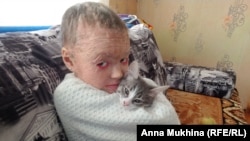 Маргарита Жигалова, девочка с ихтиозом