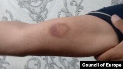 Сирожиддин Курбанов показывает синяк на руке после побоев сотрудниками милиции