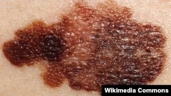 تومور پوستی